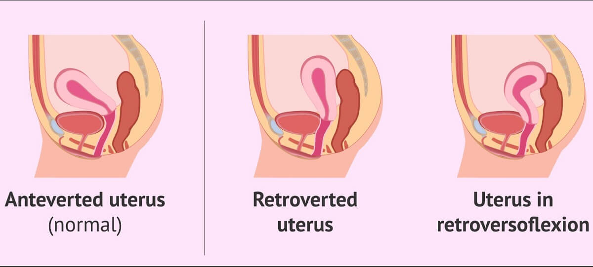 Mối quan hệ giữa tử cung ngả trước và khả năng mang thai