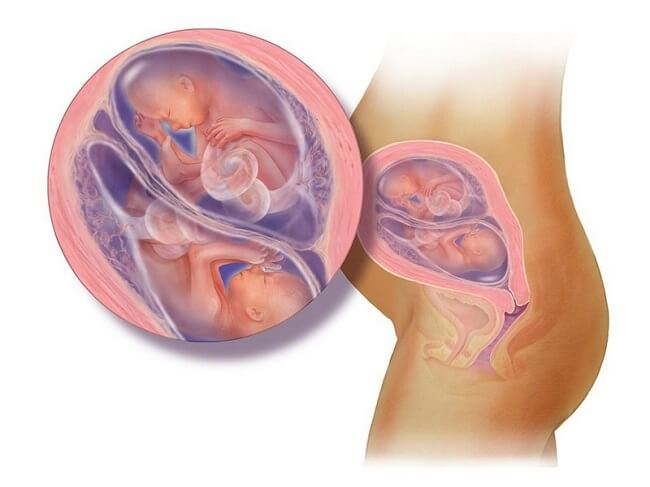 Nguy cơ mang đa thai khi tiến hành thụ tinh nhân tạo